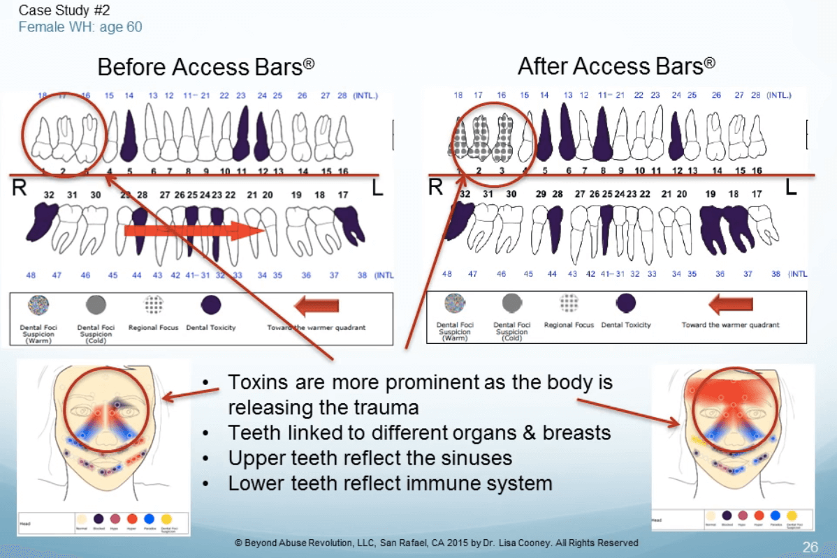 Dr. Cooney study on Access Bars and Thermometry - Case study 2 - before and after 3