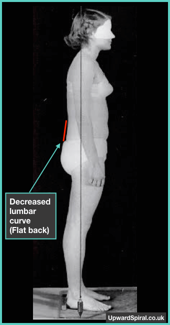 Example of flat lumbar spine, no lumbar curve