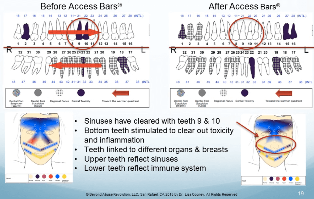 Dr. Cooney study on Access Bars and Thermometry — before and after 3 of case study 1