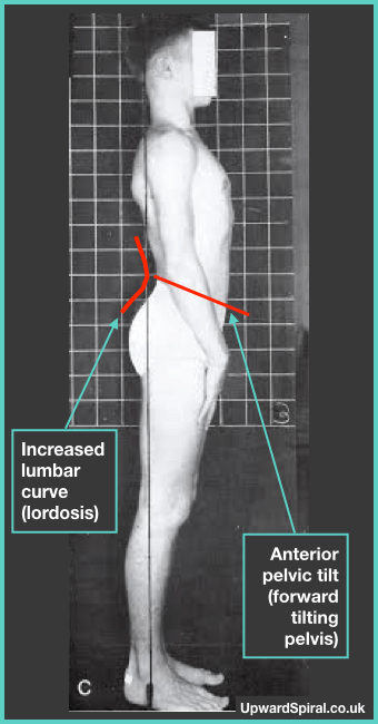Example of lumbar lordosis, excessive lumbar curve